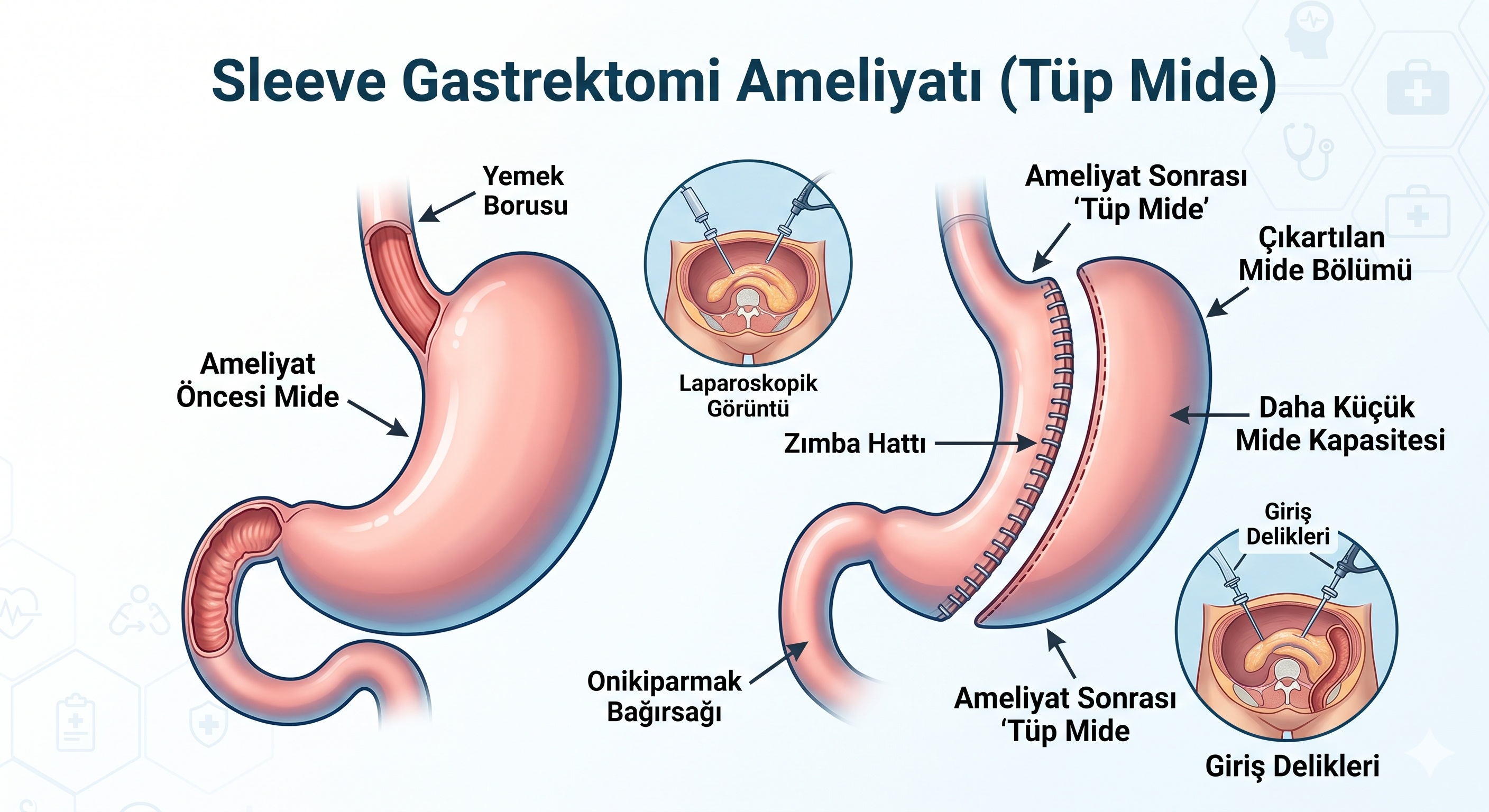 Sleeve Gastrektomi